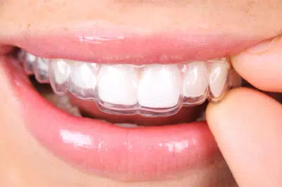 Eliners – the comfortable way to a correct bite - image 8