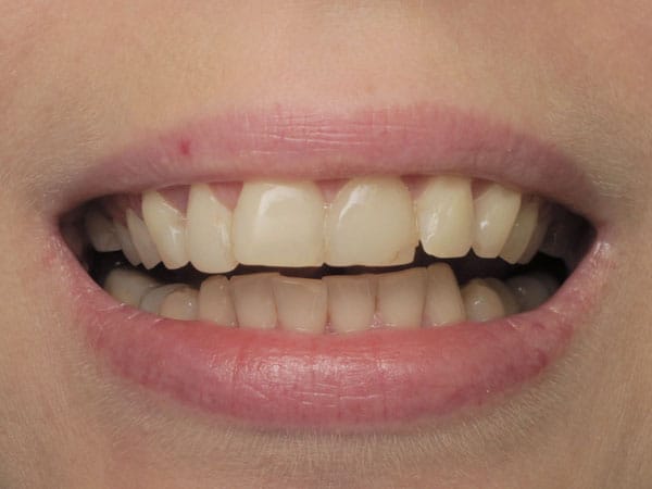 Artistic restoration Patient 1 - image 7