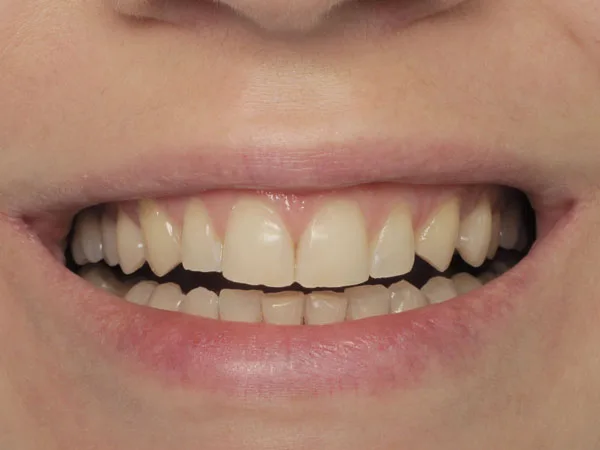 Veneers. Restoration of teeth and aesthetics - image 7