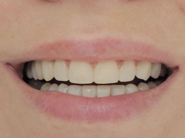 Veneers. Restoration of teeth and aesthetics - image 8