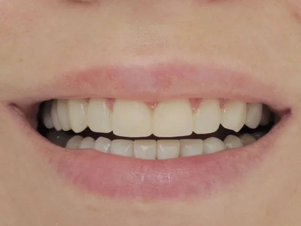 Veneers. Restoration of teeth and aesthetics - image 8