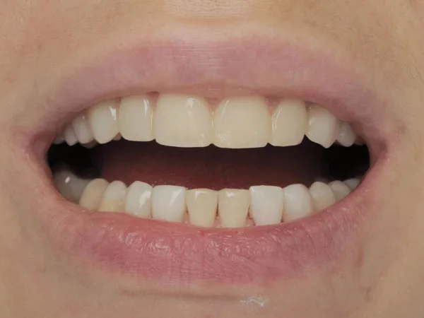 Veneers. Restoration of teeth and aesthetics - image 9