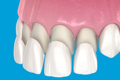 Born in Hollywood or everything you need to know about Veneers - image 7