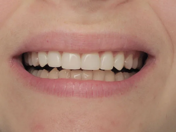 Gum curettage - image 12