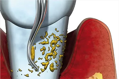 Gum curettage - image 7
