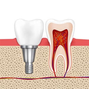 Implantation - image 7