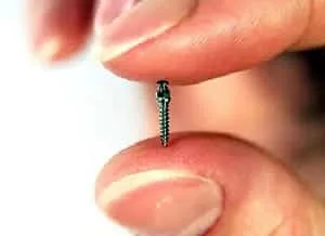 Microimplants in Orthodontics - image 8