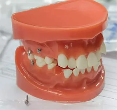 Microimplants in Orthodontics - image 7