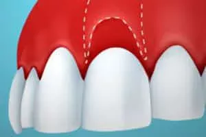 Soft tissue plasty - image 7