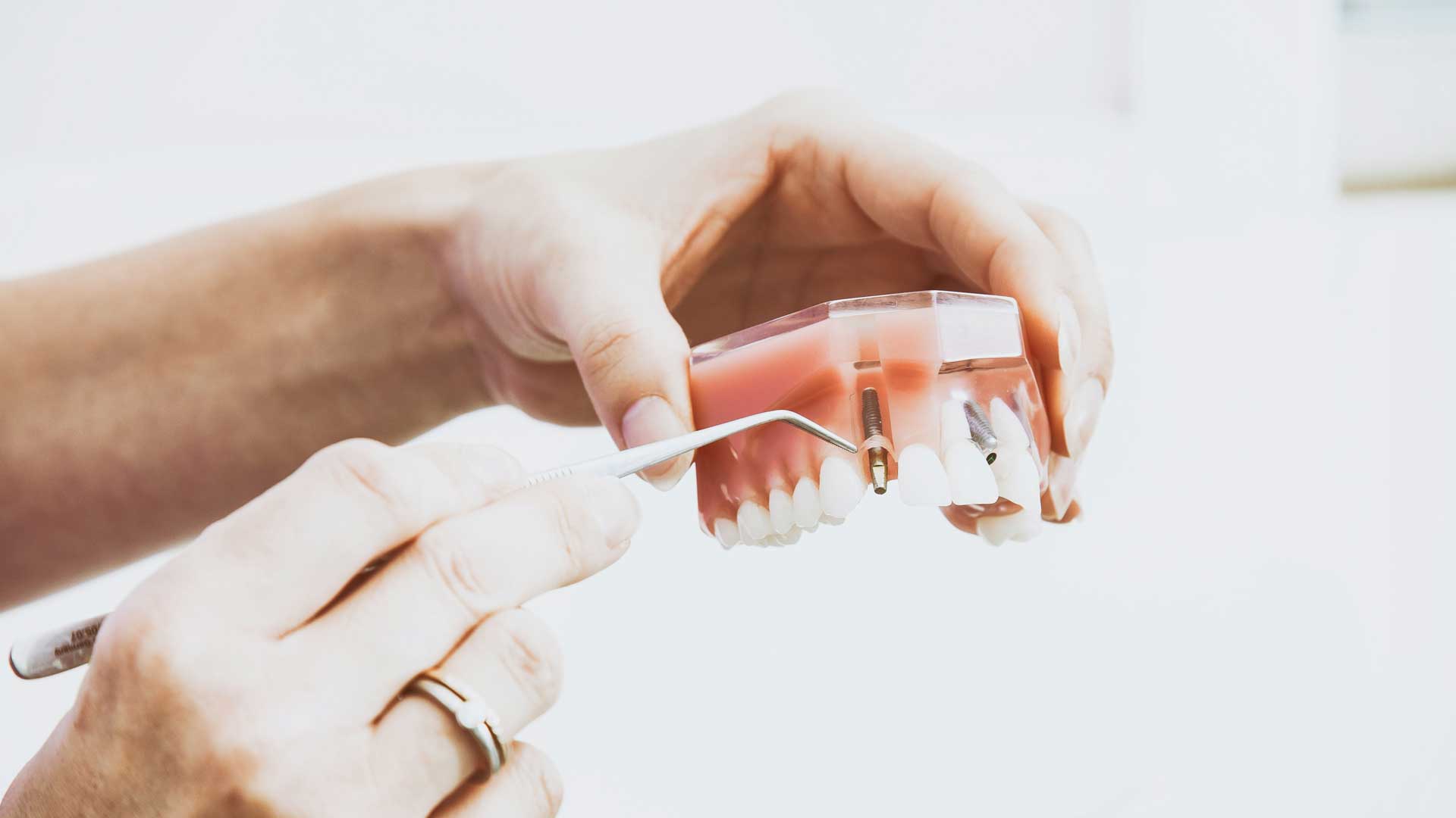 Implantology - dental implantology in Kiev | City Smile