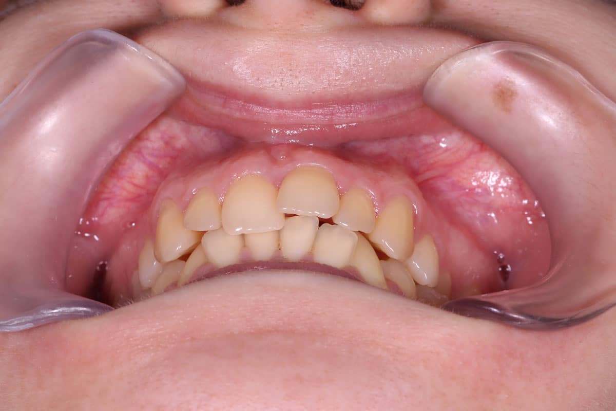 Clinical case 2: before and after braces - image 9