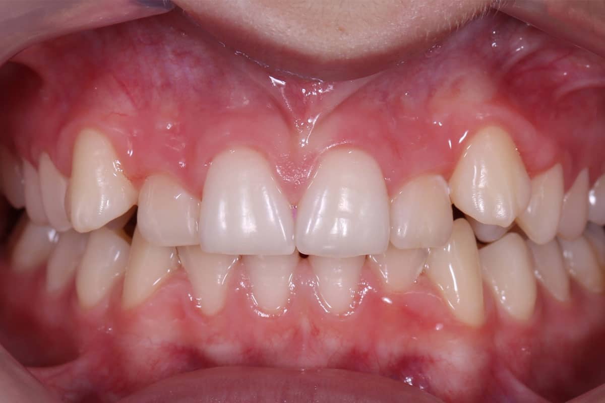 Clinical case 3: bite correction - image 8