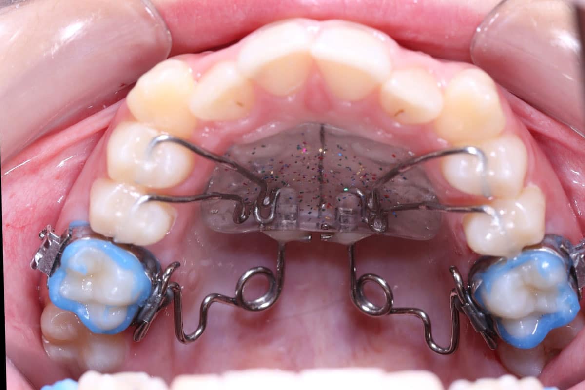 cl3-3 Clinical case 3: bite correction - image 11