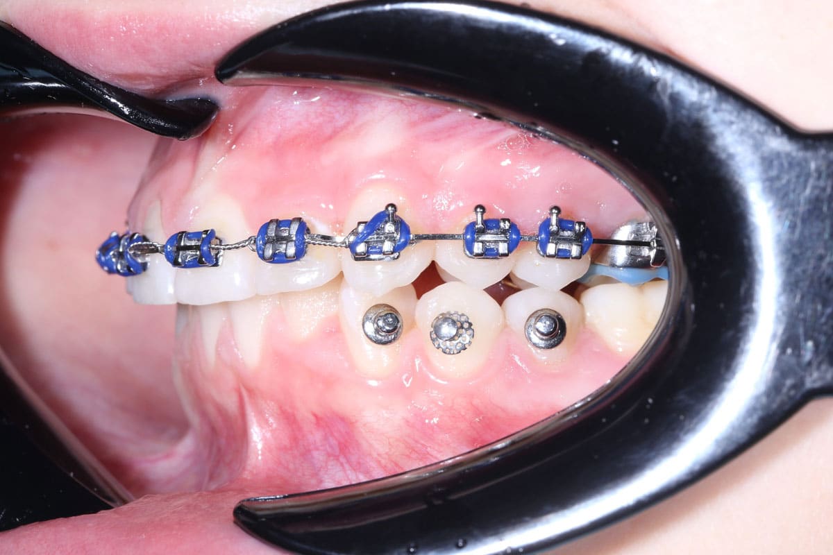 Clinical case 3: bite correction - image 18