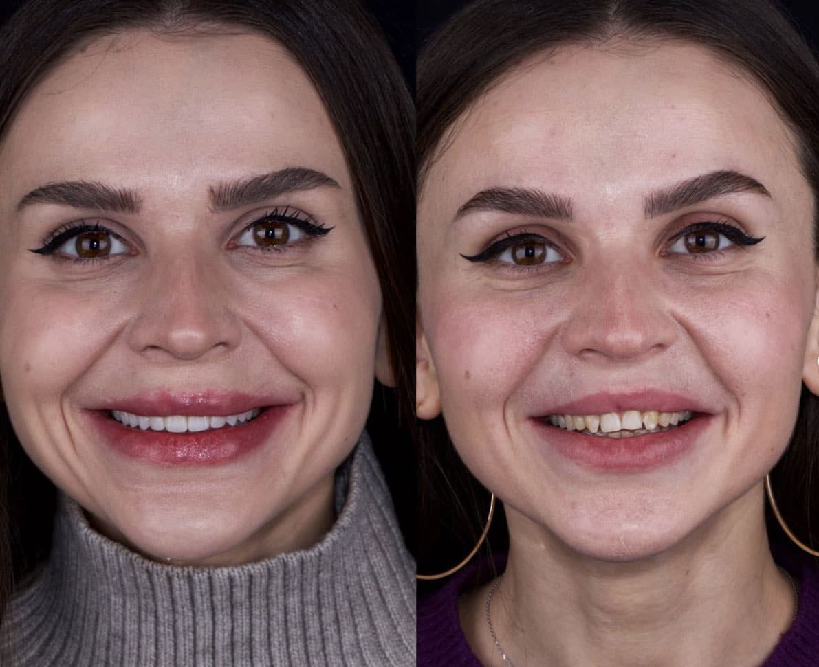 Veneers - image 7