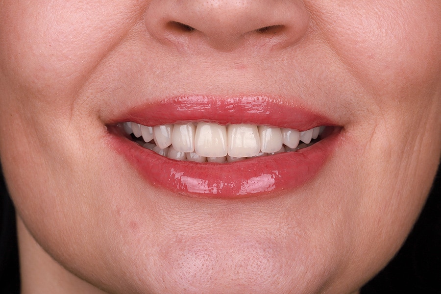 Veneers - image 8