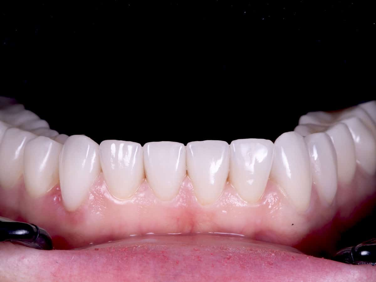 Case2Fin5 Відновлення усмішки вінірами - image 7
