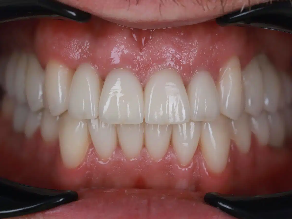 After treatment