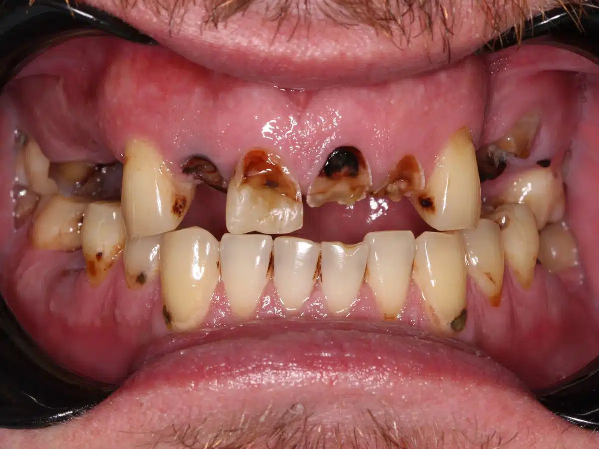  Before treatment