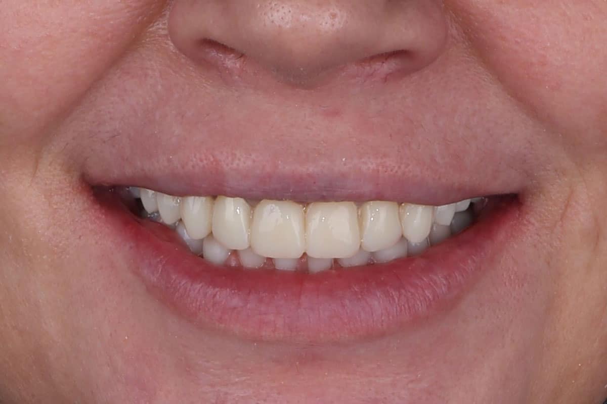 Smile restoration with veneers - image 7
